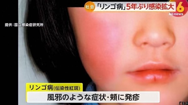 嘉汇优配交易 日本“苹果病”疫情持续流行，专家提示赴日游客做好防护